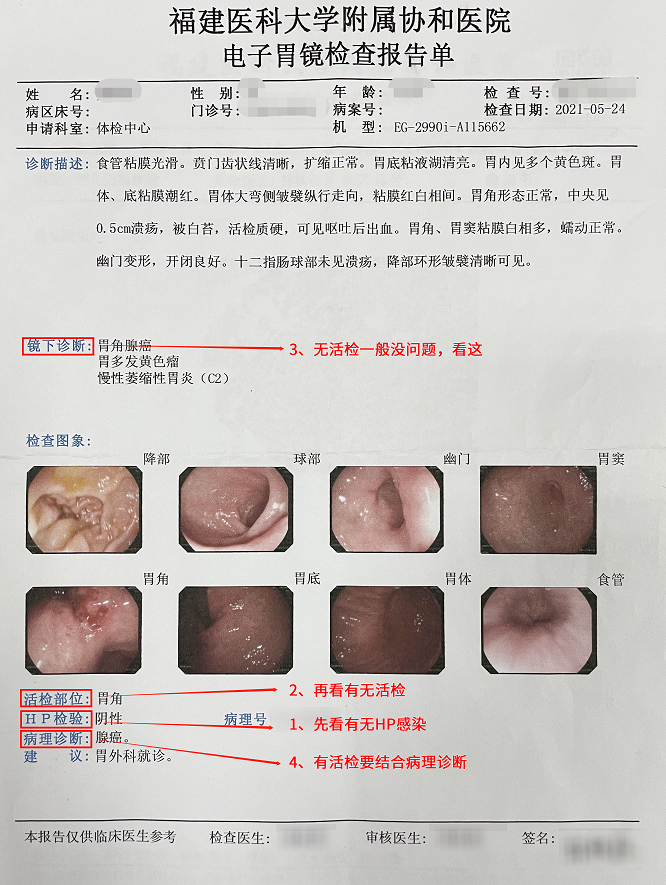 醫生說胃鏡有必要做嗎多久做一次一張胃癌篩查評分表告訴你