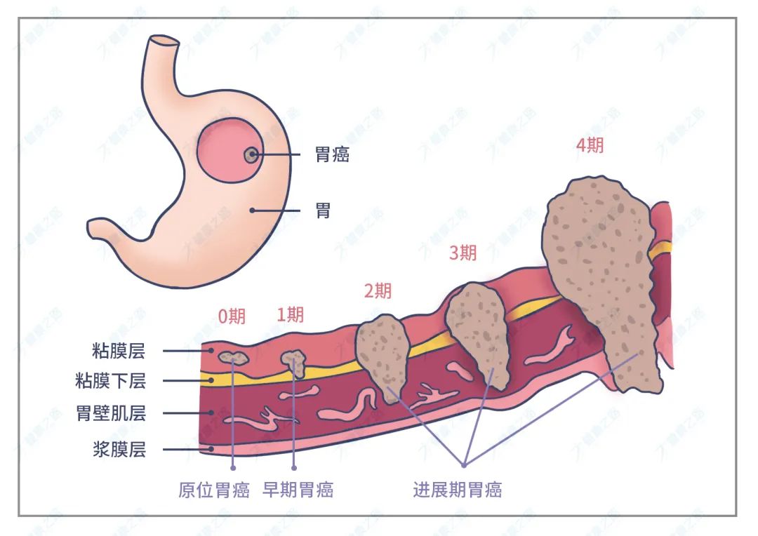 胃癌的演变过程图图片