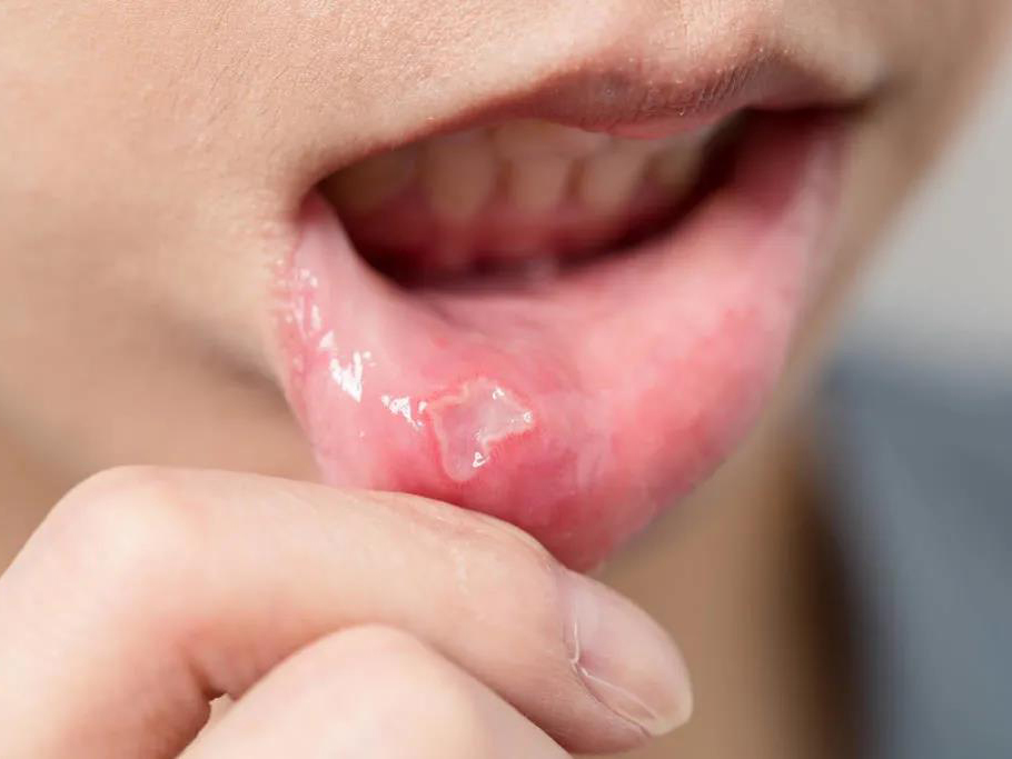 口腔溃疡痛到吃不下饭？1个方法帮你快速止痛！