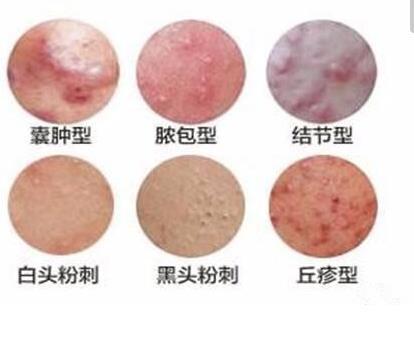 囊肿型痤疮治疗攻略