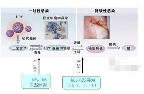 图1宫颈癌发生过程(来自网络)但从hpv感染,到发生宫颈癌大约需要6-8年