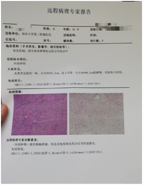 外阴肌纤维母细胞性肿瘤1例分享