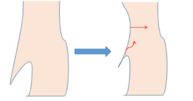 直肠前突带您了解便秘的根源之一